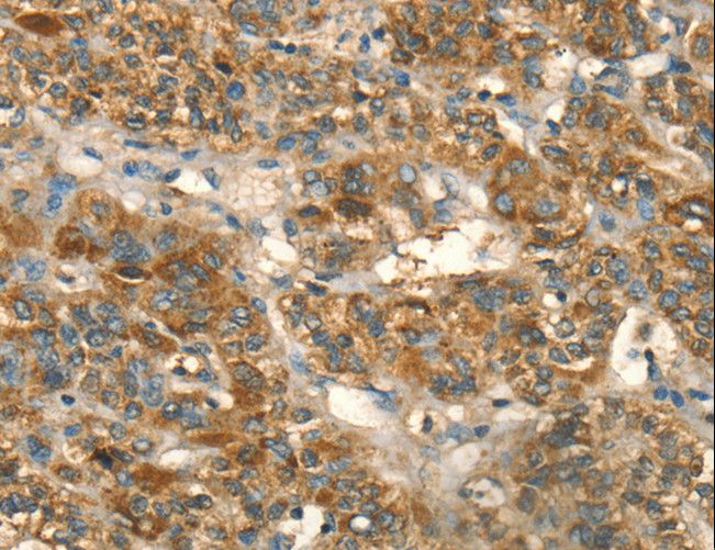HSD17B8 / RING2 Antibody - Immunohistochemistry of paraffin-embedded Human liver cancer using HSD17B8 Polyclonal Antibody at dilution of 1:55.
