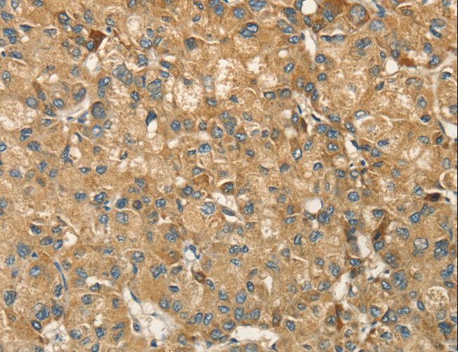 HSD17B8 / RING2 Antibody - Immunohistochemistry of paraffin-embedded Human liver cancer using HSD17B8 Polyclonal Antibody at dilution of 1:55.