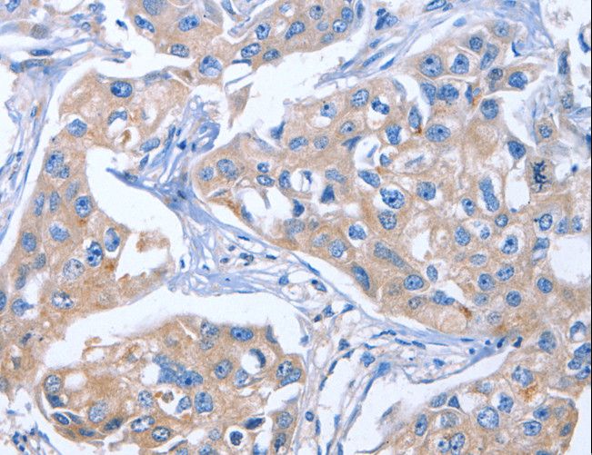 IBSP / Bone Sialoprotein Antibody - Immunohistochemistry of paraffin-embedded Human colon cancer using IBSP Polyclonal Antibody at dilution of 1:50.