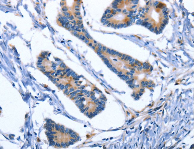 IBSP / Bone Sialoprotein Antibody - Immunohistochemistry of paraffin-embedded Human colon cancer using IBSP Polyclonal Antibody at dilution of 1:50.
