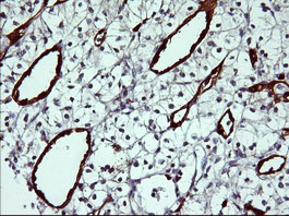 IDO1 / IDO Antibody - IHC of paraffin-embedded Carcinoma of Human kidney tissue using anti-IDO1 mouse monoclonal antibody.