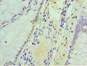 IFIT3 Antibody - Immunohistochemistry of paraffin-embedded human colon cancer using antibody at 1:100 dilution.  This image was taken for the unconjugated form of this product. Other forms have not been tested.