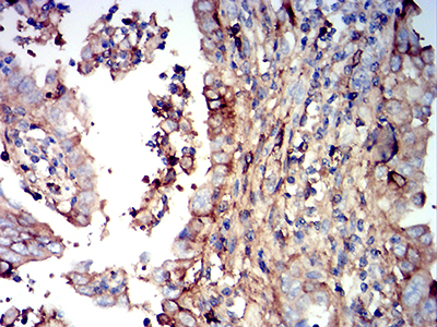 IGHM / IgM Antibody - Immunohistochemical analysis of paraffin-embedded endometrial cancer tissues using IGHM mouse mAb with DAB staining.