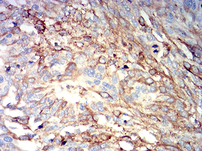 IGHM / IgM Antibody - Immunohistochemical analysis of paraffin-embedded esophageal cancer tissues using IGHM mouse mAb with DAB staining.