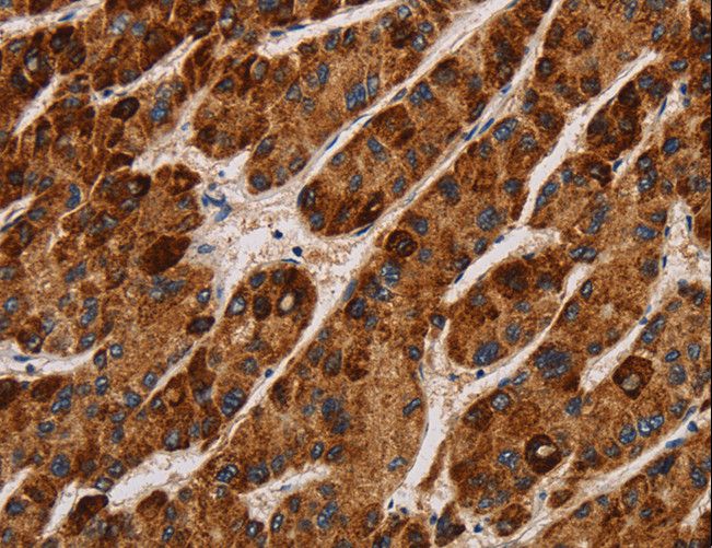 IL17RA Antibody - Immunohistochemistry of paraffin-embedded Human liver cancer using IL17RA Polyclonal Antibody at dilution of 1:40.