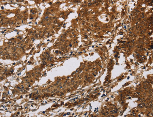 IL17RB Antibody - Immunohistochemistry of paraffin-embedded Human gastric cancer using IL17RB Polyclonal Antibody at dilution of 1:40.