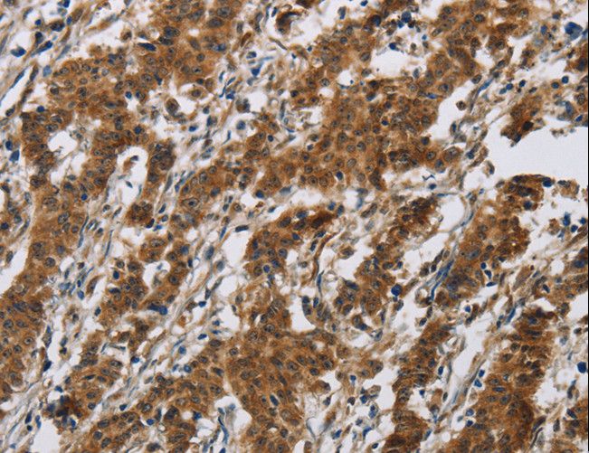 IL17RB Antibody - Immunohistochemistry of paraffin-embedded Human gastric cancer using IL17RB Polyclonal Antibody at dilution of 1:40.