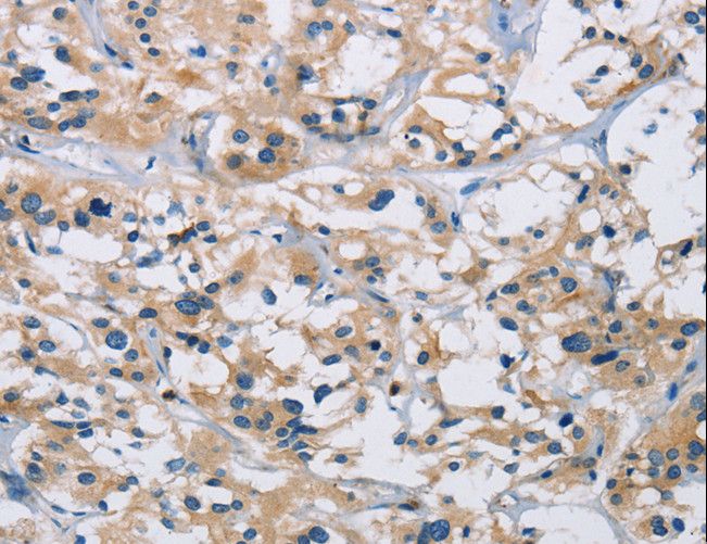 IL17RB Antibody - Immunohistochemistry of paraffin-embedded Human thyroid cancer using IL17RB Polyclonal Antibody at dilution of 1:40.