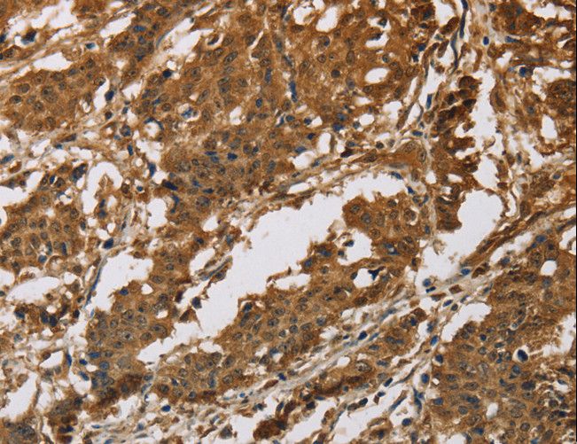 IL19 Antibody - Immunohistochemistry of paraffin-embedded Human gastric cancer using IL19 Polyclonal Antibody at dilution of 1:40.