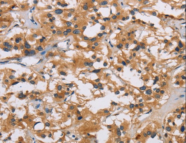 IL19 Antibody - Immunohistochemistry of paraffin-embedded Human thyroid cancer using IL19 Polyclonal Antibody at dilution of 1:40.