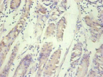 IL8 / Interleukin 8 Antibody - Immunohistochemical of paraffin-embedded human gastric cancer tissue using CXCL8 Monoclonal Antibody at dilution of 1:200.