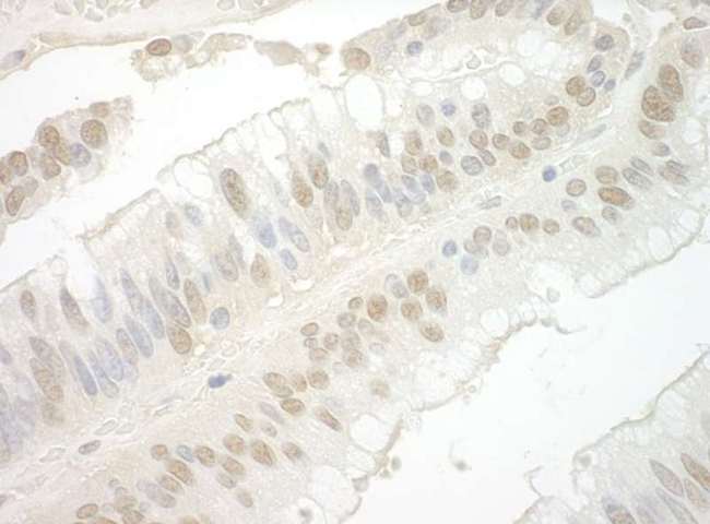 IPO7 / RANBP7 Antibody - Detection of Human Importin 7 by Immunohistochemistry. Sample: FFPE section of human colon carcinoma. Antibody: Affinity purified rabbit anti-Importin 7 used at a dilution of 1:1000 (0.2 ug/mg).