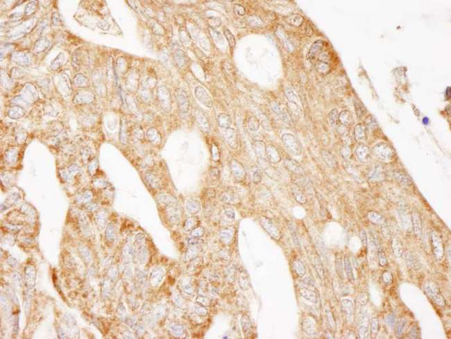 IRS2 / IRS-2 Antibody - Detection of Human IRS2 by Immunohistochemistry. Sample: FFPE section of human ovarian carcinoma. Antibody: Affinity purified rabbit anti-IRS2 used at a dilution of 1:1000 (1 Detection: DAB.