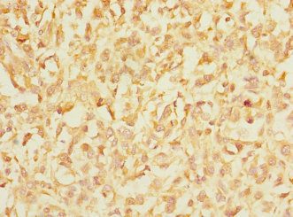 ITGAE / CD103 Antibody - Immunohistochemistry of paraffin-embedded human melanoma at dilution 1:100