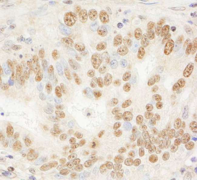JHDM1A / KDM2A Antibody - Detection of Human JHDM1A by Immunohistochemistry. Sample: FFPE section of human stomach carcinoma. Antibody: Affinity purified rabbit anti-JHDM1A used at a dilution of 1:200 (1 ug/ml). Detection: DAB.