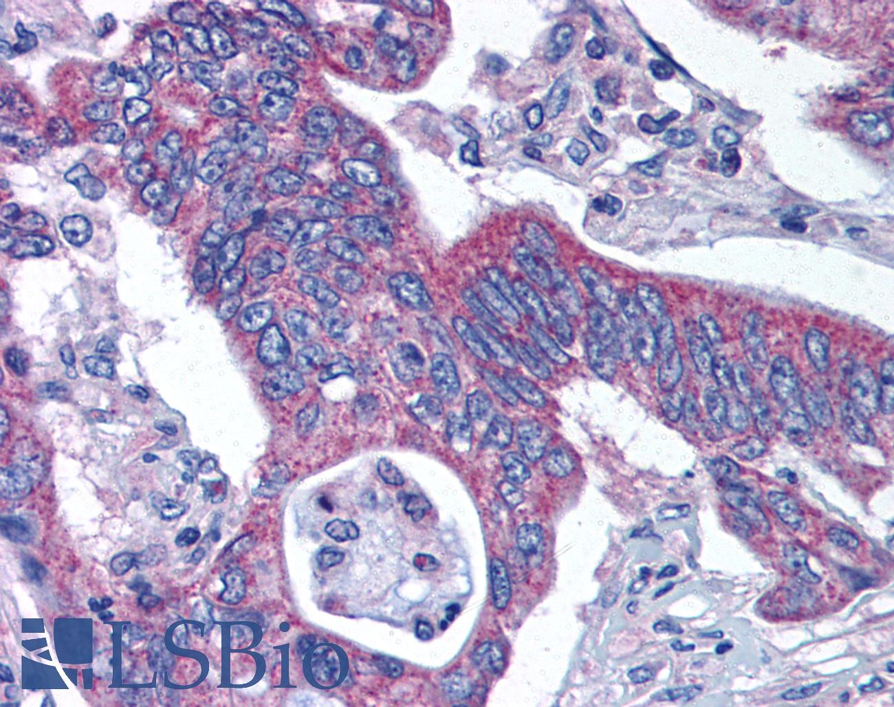 KATII / AADAT Antibody - Anti-KATII / AADAT antibody IHC of human Colon, Carcinoma. Immunohistochemistry of formalin-fixed, paraffin-embedded tissue after heat-induced antigen retrieval.