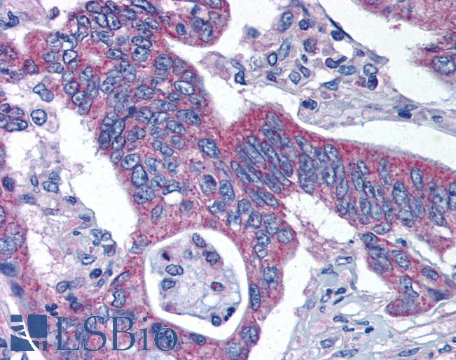 KATII / AADAT Antibody - Anti-KATII / AADAT antibody IHC of human Colon, Carcinoma. Immunohistochemistry of formalin-fixed, paraffin-embedded tissue after heat-induced antigen retrieval.