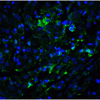 KDM1A / LSD1 Antibody - Immunofluorescence of LSD1 in human breast carcinoma tissue with LSD1 antibody at 20 µg/ml.Green: LSD1 Antibody  Blue: DAPI staining