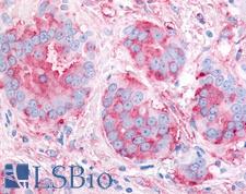 KDR / VEGFR2 / FLK1 Antibody - Anti-KDR / VEGFR2 antibody IHC of human Breast, Carcinoma. Immunohistochemistry of formalin-fixed, paraffin-embedded tissue after heat-induced antigen retrieval.