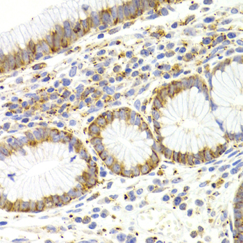 KISS1R / GPR54 Antibody - Immunohistochemistry of paraffin-embedded human stomach cancer tissue.