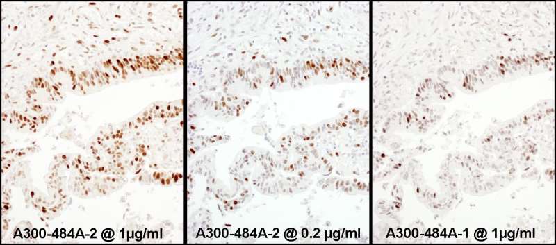 KPNA2 / Importin Alpha 1 Antibody - Detection of Human RCH1 by Immunohistochemistry. Samples: FFPE serial sections of human colon carcinoma. Antibody: Affinity purified rabbit anti-RCH1 used at a dilution of 1:1000 (1 ug/ml) and 1:5000 (0.2 ug/ml). Detection: DAB.