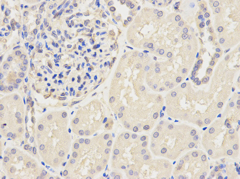 KPNA2 / Importin Alpha 1 Antibody - Immunohistochemistry of paraffin-embedded human stomach cancer using KPNA2 antibody at dilution of 1:200 (400x lens).
