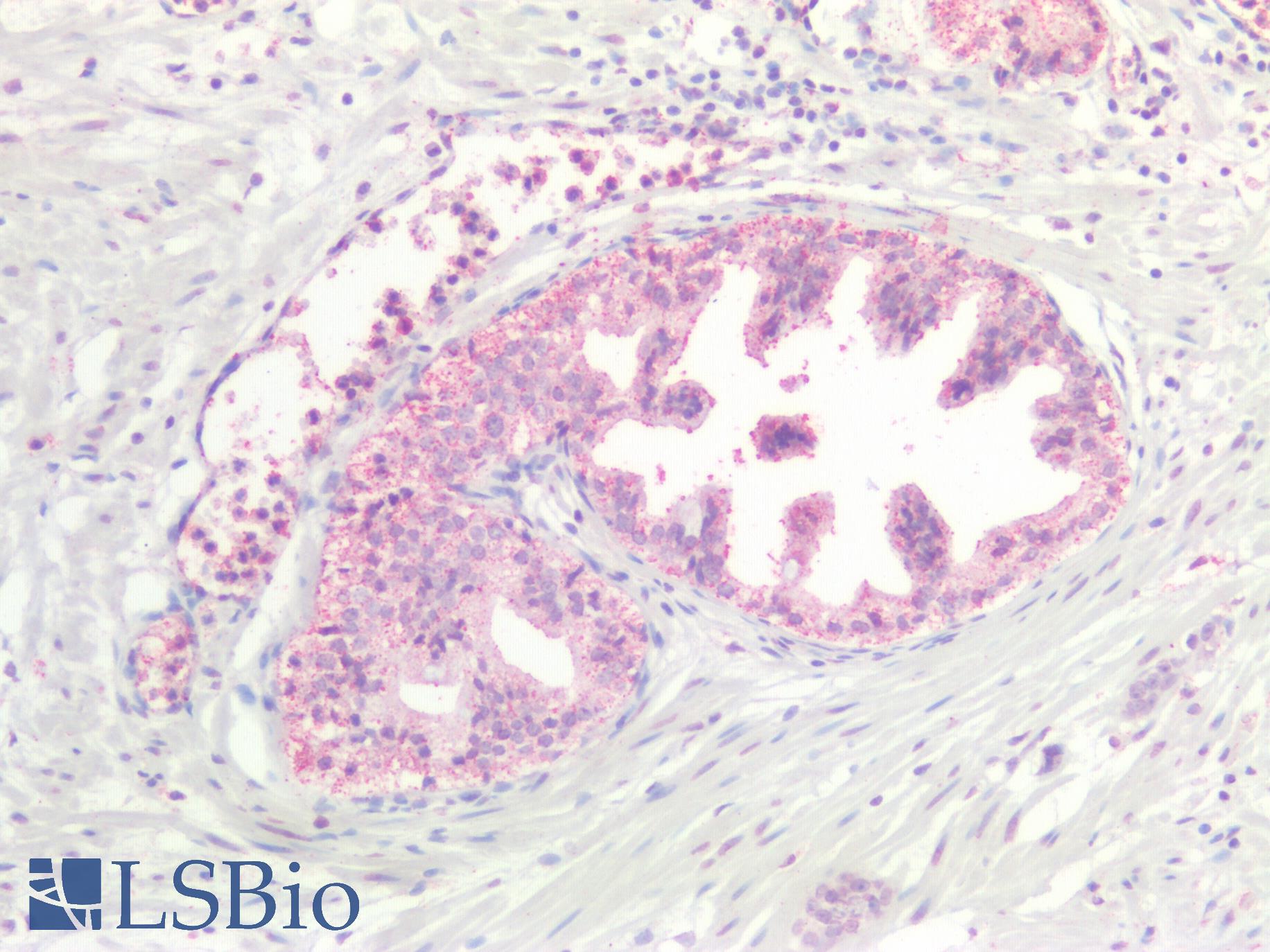 KRAS Antibody - Human Prostate Carcinoma: Formalin-Fixed, Paraffin-Embedded (FFPE)