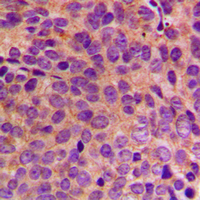 KRT18 / CK18 / Cytokeratin 18 Antibody - Immunohistochemical analysis of Cytokeratin 18 staining in human breast cancer formalin fixed paraffin embedded tissue section. The section was pre-treated using heat mediated antigen retrieval with sodium citrate buffer (pH 6.0). The section was then incubated with the antibody at room temperature and detected using an HRP conjugated compact polymer system. DAB was used as the chromogen. The section was then counterstained with hematoxylin and mounted with DPX.