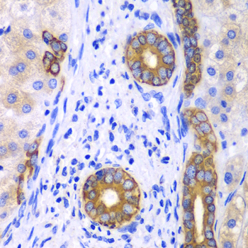 KRT19 / CK19 / Cytokeratin 19 Antibody - Immunohistochemistry of paraffin-embedded human liver cancer tissue, with a concentration of 1:100.