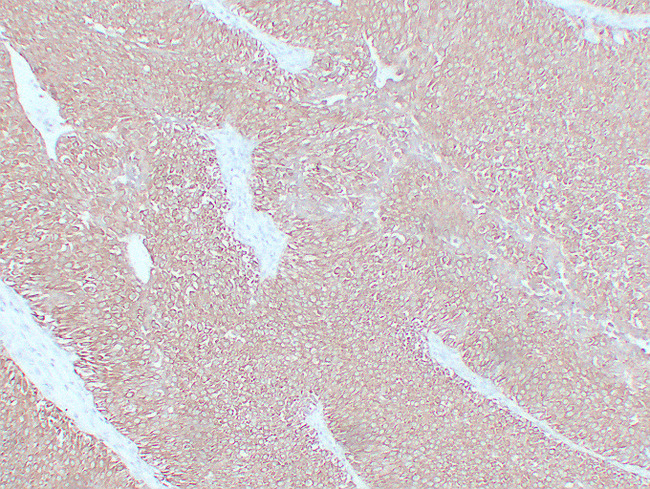 KRT7 / CK7 / Cytokeratin 7 Antibody - Bladder Transitional Cell Carcinoma 1