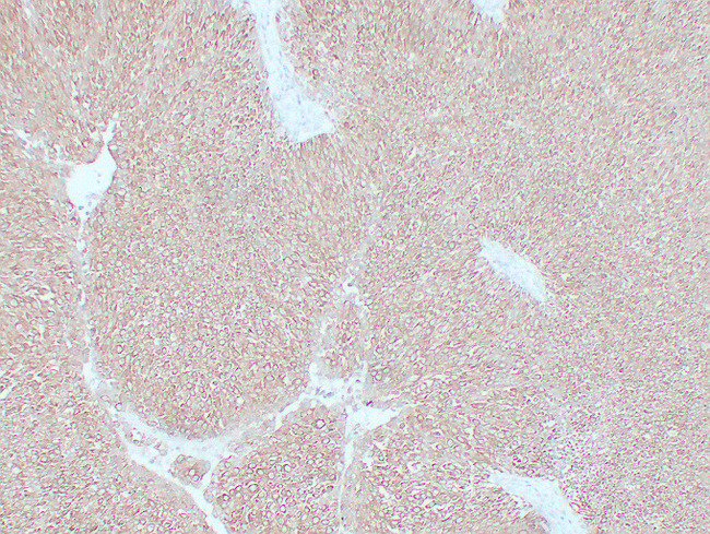 KRT7 / CK7 / Cytokeratin 7 Antibody - Bladder Transitional Cell Carcinoma 3