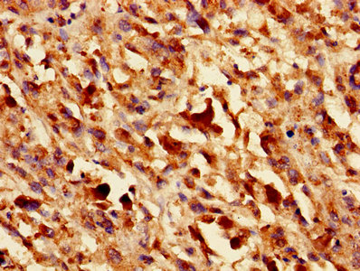 LGALS1 / Galectin 1 Antibody - Immunohistochemistry of paraffin-embedded human colon cancer using LGALS1 Antibody at dilution of 1:100