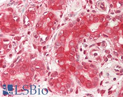 LGALS3 / Galectin 3 Antibody - Human Breast: Formalin-Fixed, Paraffin-Embedded (FFPE)