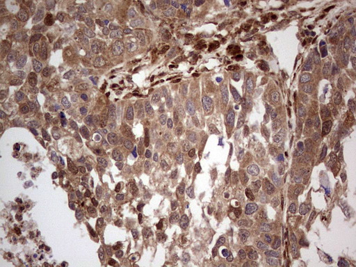 LGALS9 / Galectin 9 Antibody - IHC of paraffin-embedded Carcinoma of Human kidney tissue using anti-LGALS9 mouse monoclonal antibody. (Heat-induced epitope retrieval by 1 mM EDTA in 10mM Tris, pH8.5, 120°C for 3min).