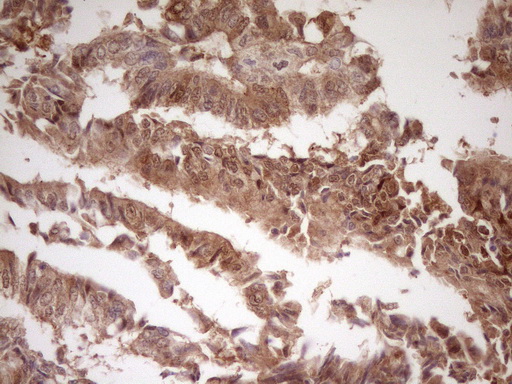 LGALS9 / Galectin 9 Antibody - IHC of paraffin-embedded Adenocarcinoma of Human colon tissue using anti-LGALS9 mouse monoclonal antibody. (Heat-induced epitope retrieval by 1 mM EDTA in 10mM Tris, pH8.5, 120°C for 3min).
