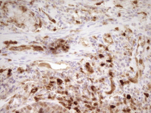 LGALS9 / Galectin 9 Antibody - IHC of paraffin-embedded Carcinoma of Human lung tissue using anti-LGALS9 mouse monoclonal antibody. (Heat-induced epitope retrieval by 1 mM EDTA in 10mM Tris, pH8.5, 120°C for 3min).
