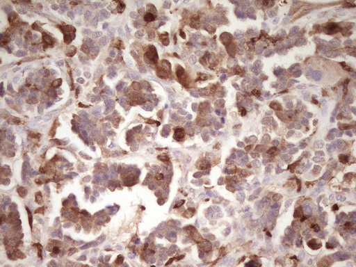 LGALS9 / Galectin 9 Antibody - IHC of paraffin-embedded Adenocarcinoma of Human ovary tissue using anti-LGALS9 mouse monoclonal antibody. (Heat-induced epitope retrieval by 1 mM EDTA in 10mM Tris, pH8.5, 120°C for 3min).