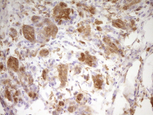 LGALS9 / Galectin 9 Antibody - IHC of paraffin-embedded Carcinoma of Human pancreas tissue using anti-LGALS9 mouse monoclonal antibody. (Heat-induced epitope retrieval by 1 mM EDTA in 10mM Tris, pH8.5, 120°C for 3min).