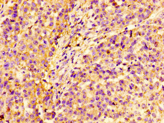 LIMS1 / PINCH Antibody - Immunohistochemistry image at a dilution of 1:100 and staining in paraffin-embedded human colon cancer performed on a Leica BondTM system. After dewaxing and hydration, antigen retrieval was mediated by high pressure in a citrate buffer (pH 6.0) . Section was blocked with 10% normal goat serum 30min at RT. Then primary antibody (1% BSA) was incubated at 4 °C overnight. The primary is detected by a biotinylated secondary antibody and visualized using an HRP conjugated SP system.