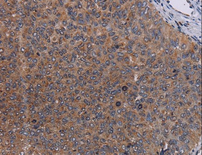LIPE / HSL Antibody - Immunohistochemistry of paraffin-embedded Human renal cancer using LIPE Polyclonal Antibody at dilution of 1:50.