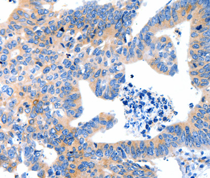 LRPAP1 Antibody - Immunohistochemistry of paraffin-embedded human colon cancer tissue using LRPAP1 antibody.