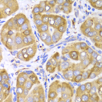 LRPAP1 Antibody - Immunohistochemistry of paraffin-embedded liver cancer tissue.