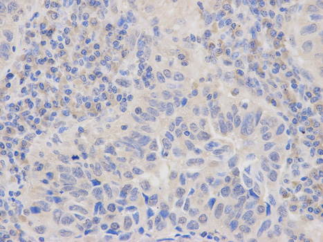 LY96 / MD2 / MD-2 Antibody - Immunohistochemistry of paraffin-embedded human endometrial cancer using LY96 antibody at dilution of 1:100 (400x lens).