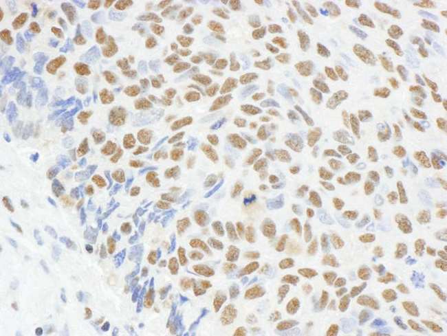 MAD2L1 / MAD2 Antibody - Detection of Human MAD2 by Immunohistochemistry. Sample: FFPE section of human lung carcinoma. Antibody: Affinity purified rabbit anti-MAD2 used at a dilution of 1:1000 (1 ug/ml). Detection: DAB.