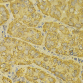 MAOA / Monoamine Oxidase Antibody - Immunohistochemistry of paraffin-embedded human liver cancer tissue.
