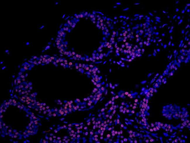 MATR3 / Matrin 3 Antibody - Detection of Human Matrin 3 by Immunofluorescence. Sample: FFPE section of human breast carcinoma. Antibody: Affinity purified rabbit anti-Matrin 3 used at a dilution of 1:100. Detection: Red-fluorescent Alexa Fluor 555 goat anti-rabbit IgG (Invitrogen) used at a dilution of 1:500.