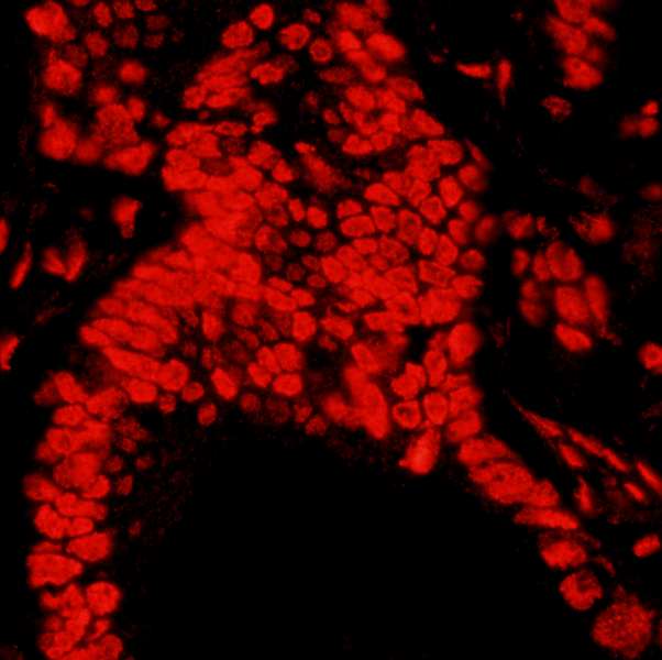 MATR3 / Matrin 3 Antibody - Detection of Human Matrin 3 by Immunofluorescence. Sample: FFPE section of human stomach carcinoma. Antibody: Affinity purified rabbit anti-Matrin 3 used at a dilution of 1:400 (0.5 ug/ml). Detection: Red-fluorescent Goat anti-Rabbit IgG-heavy and light chain cross-adsorbed Antibody DyLight 594 Conjugated (A120-601D4) used at a dilution of 1:100.