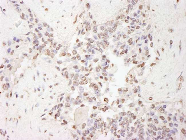 MBD2 Antibody - Detection of Human MBD2 by Immunohistochemistry. Sample: FFPE section of human prostate carcinoma. Antibody: Affinity purified rabbit anti-MBD2 used at a dilution of 1:200 (1 Detection: DAB.