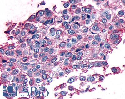 MC1R Antibody - Anti-MC1 Receptor antibody IHC of human skin, melanoma. Immunohistochemistry of formalin-fixed, paraffin-embedded tissue after heat-induced antigen retrieval.