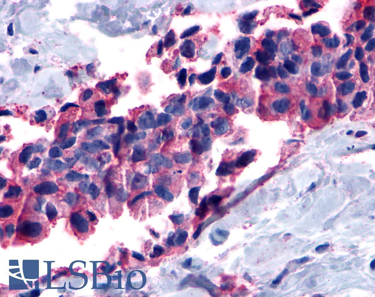 MC1R Antibody - Breast, carcinoma